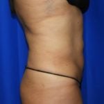 Liposuction Before & After Patient #2362