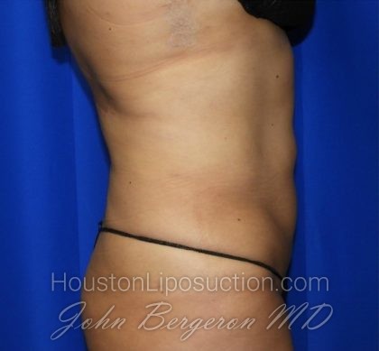 Liposuction Before & After Patient #2362