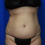 Liposuction Before & After Patient #2353