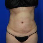 Liposuction Before & After Patient #2353