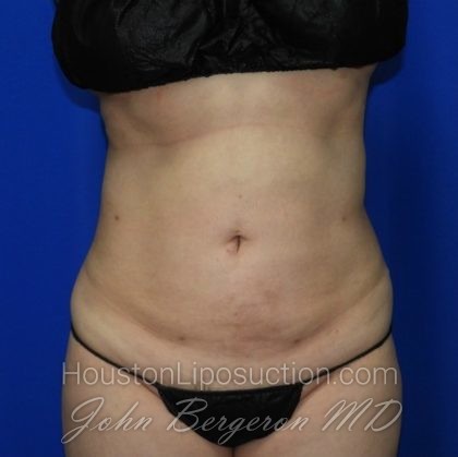 Liposuction Before & After Patient #2353