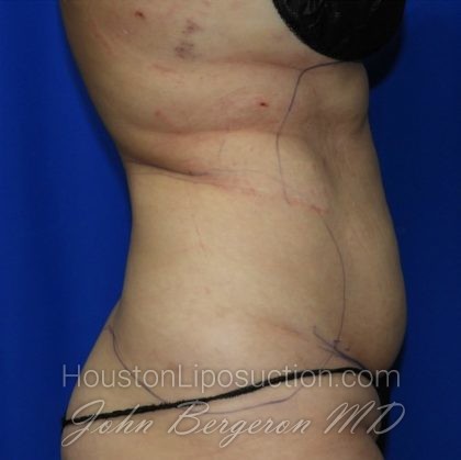 Liposuction Before & After Patient #2353