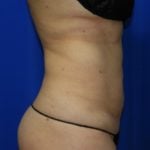 Liposuction Before & After Patient #2353