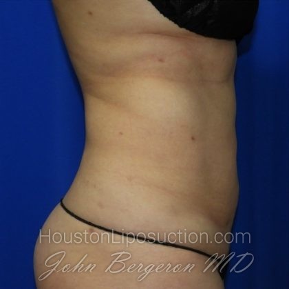 Liposuction Before & After Patient #2353