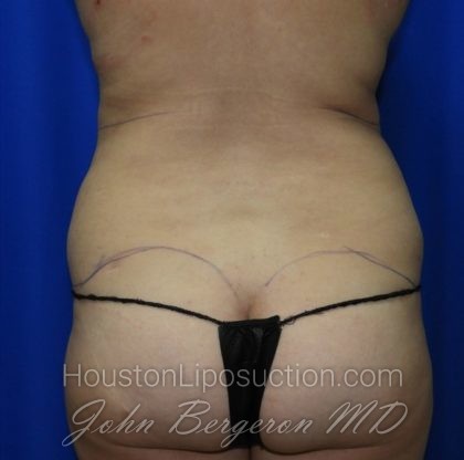 Liposuction Before & After Patient #2353