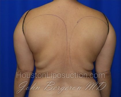 Liposuction Before & After Patient #2353