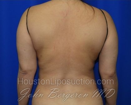 Liposuction Before & After Patient #2353