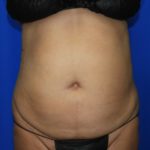 Liposuction Before & After Patient #2354