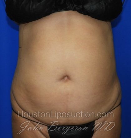 Liposuction Before & After Patient #2354