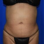 Liposuction Before & After Patient #2354