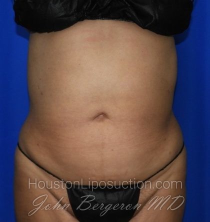 Liposuction Before & After Patient #2354