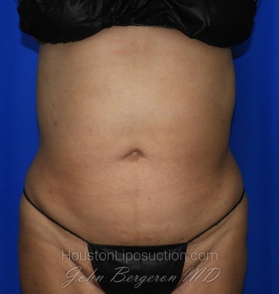 Liposuction Before & After Patient #2354