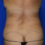 Liposuction Before & After Patient #2354