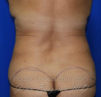 Liposuction Before & After Patient #2354