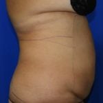 Liposuction Before & After Patient #2354