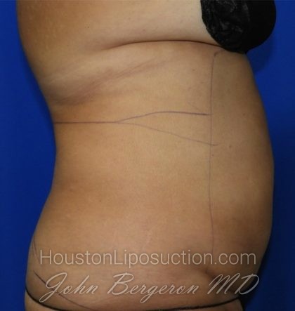 Liposuction Before & After Patient #2354