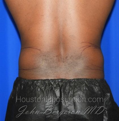 Liposuction Before & After Patient #2385