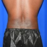 Liposuction Before & After Patient #2385