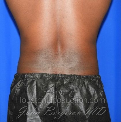Liposuction Before & After Patient #2385