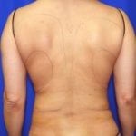 Liposuction Before & After Patient #2377