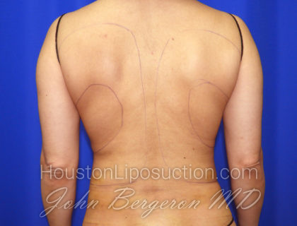 Liposuction Before & After Patient #2377