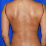 Liposuction Before & After Patient #2377