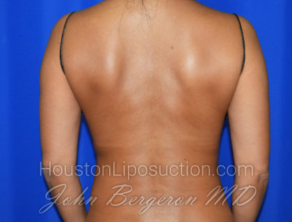 Liposuction Before & After Patient #2377