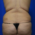 Liposuction Before & After Patient #2388