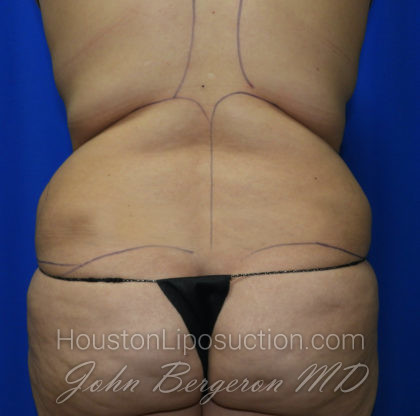 Liposuction Before & After Patient #2388