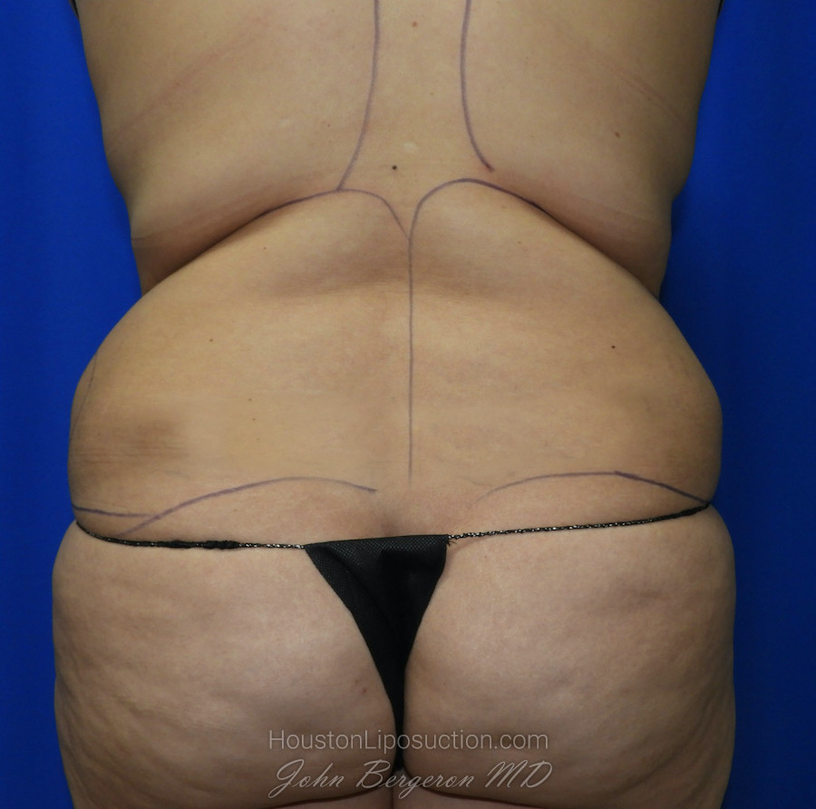 Liposuction Before & After Patient #2388