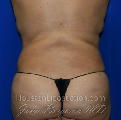 Liposuction Before & After Patient #2388