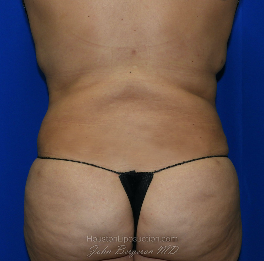 Liposuction Before & After Patient #2388
