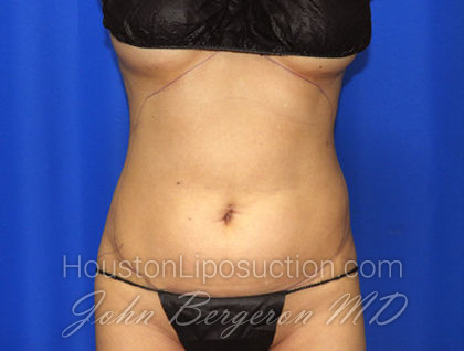 Liposuction Before & After Patient #2372