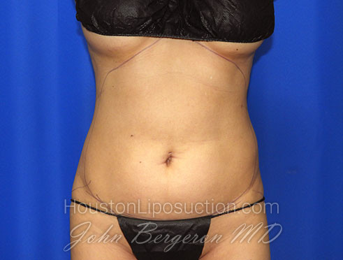 Liposuction Before & After Patient #2372