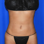 Liposuction Before & After Patient #2372