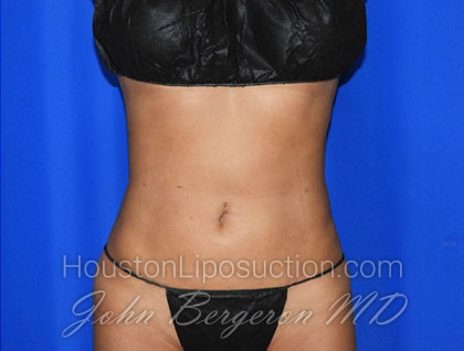 Liposuction Before & After Patient #2372