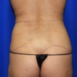 Liposuction Before & After Patient #2372