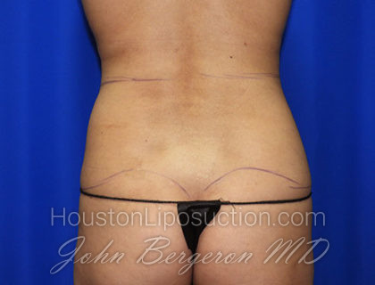 Liposuction Before & After Patient #2372