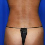 Liposuction Before & After Patient #2372