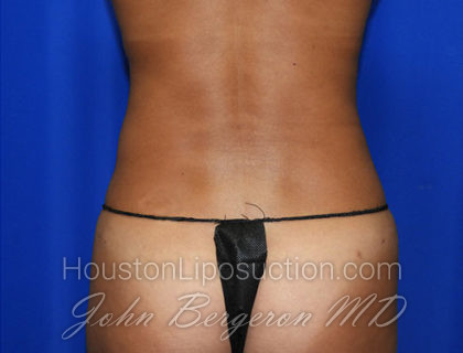 Liposuction Before & After Patient #2372