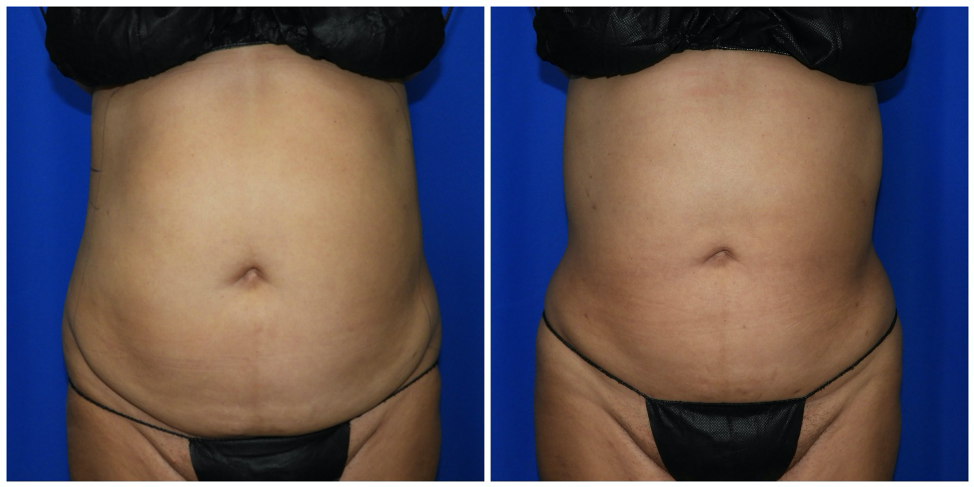 Abs & Waist Liposuction Before & After