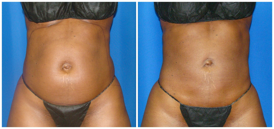 360 liposuction procedure houston