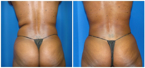 360 liposuction procedure houston