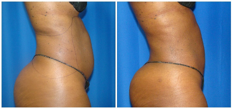 360 liposuction procedure houston