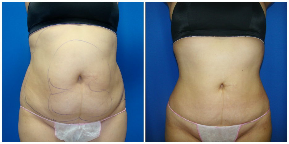 Waist & Hip Liposuction / Houston Lipo Center