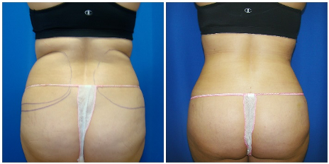 360 liposuction procedure houston