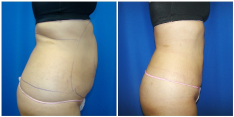 Waist & Hip Liposuction / Houston Lipo Center