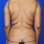 Liposuction Before & After Patient #2463