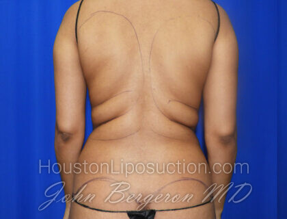 Liposuction Before & After Patient #2463