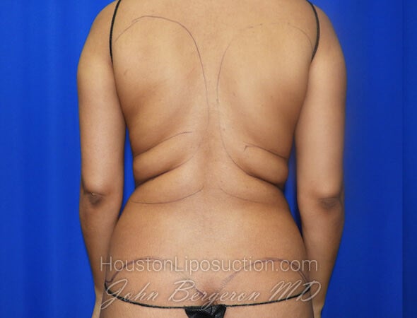 Liposuction Before & After Patient #2463